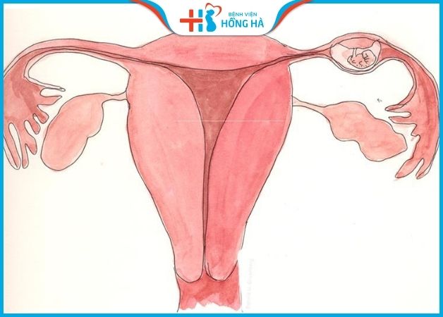 Dính buồng tử cung không thể làm IVF nên cần phải điều trị dứt điểm trước khi thực hiện kỹ thuật này