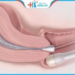 Làm IUI có bị chửa ngoài tử cung không? Những điều cần biết