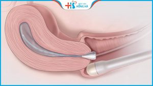 Làm IUI có bị chửa ngoài tử cung không? Những điều cần biết