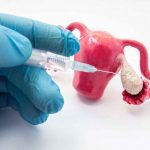 Làm IVF có đau không? Kinh nghiệm làm giảm cơn đau khi thực hiện IVF