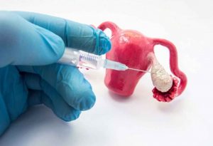 Làm IVF có đau không? Kinh nghiệm làm giảm cơn đau khi thực hiện IVF