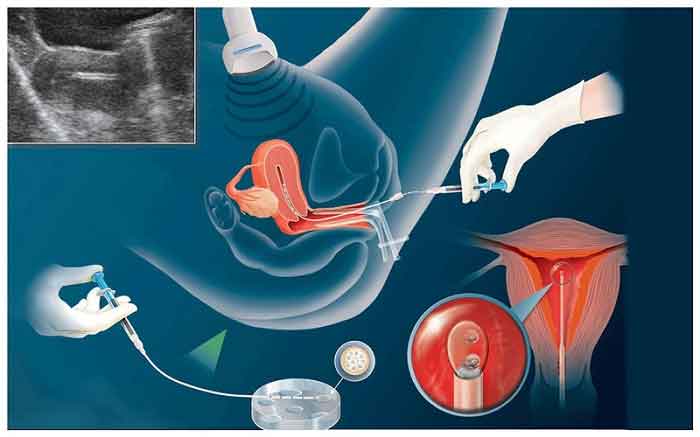Thụ-tinh-nhân-tạo là phương pháp chọn lọc tinh trùng khỏe bơm vào tử cung 