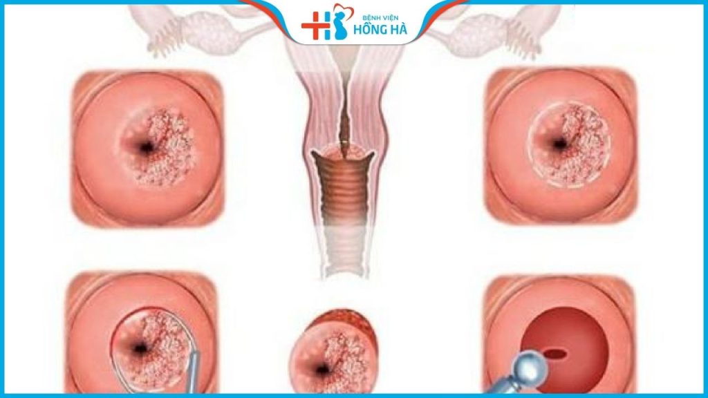 Viêm cổ tử cung và nguy cơ xung huyết: Cần phát hiện và điều trị sớm