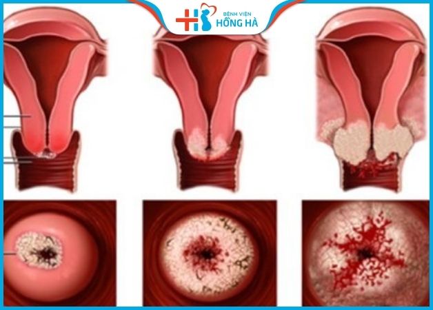 Viêm cổ tử cung xung huyết là tình trạng máu chảy tăng cường