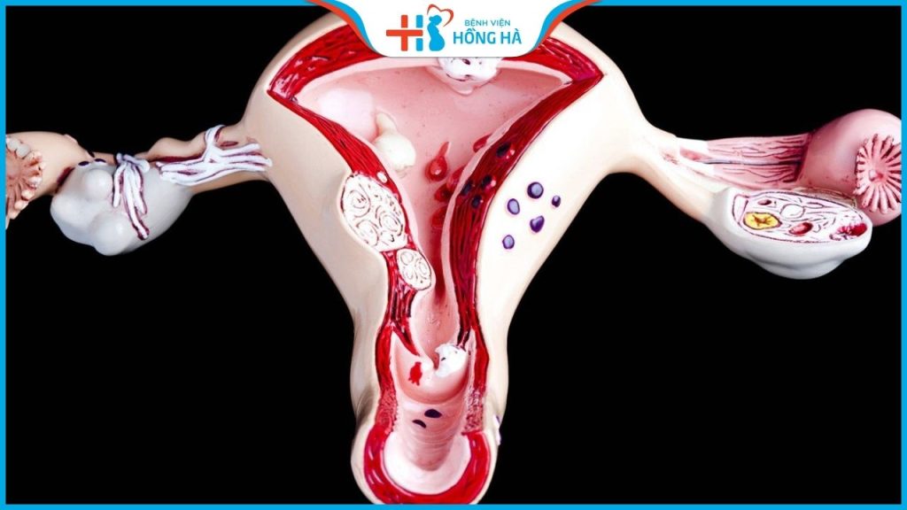 Điều trị viêm nội mạc tử cung thành công 80%: Những phương pháp nên dùng