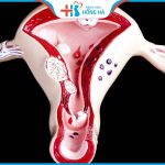 Điều trị viêm nội mạc tử cung thành công 80%: Những phương pháp nên dùng