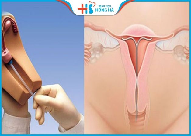 Điều trị viêm cổ tử cung là dừng tiếp xúc với các dị vật