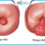 Polyp cổ tử cung có tự rụng không – Chẩn đoán và điều trị hiệu quả