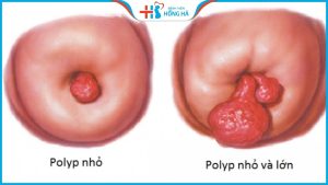 Polyp cổ tử cung có tự rụng không – Chẩn đoán và điều trị hiệu quả