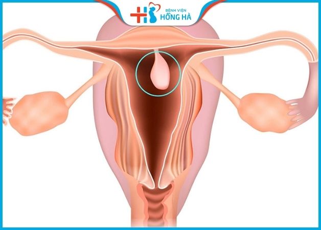 Polyp cổ tử cung là những khối u phát triển tại cổ tử cung