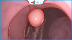 Điều trị hoại tử polyp tử cung: phương pháp và kỹ thuật hiện đại