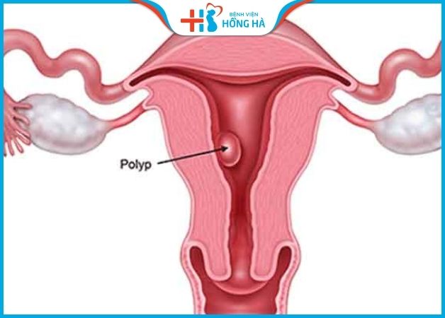 Polyp cổ tử cung bị hoại tử khi mang thai là sự xuất hiện của các cục u li ti
