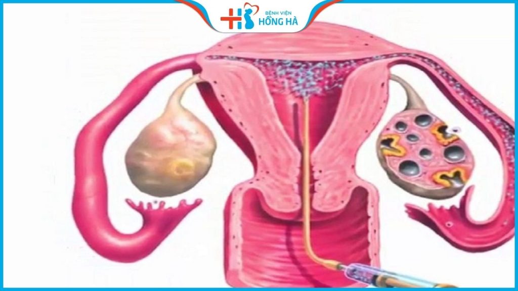 Chi tiết quá trình thụ tinh nhân tạo chia sẻ từ chuyên gia sản khoa