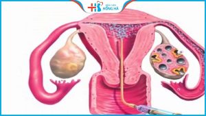Chi tiết quá trình thụ tinh nhân tạo chia sẻ từ chuyên gia sản khoa