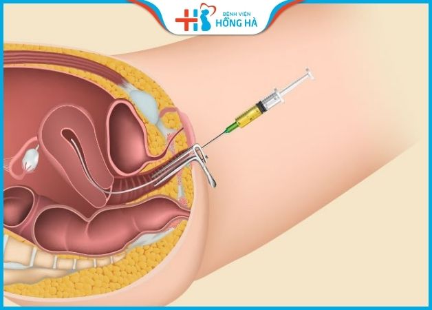 Kỹ thuật thụ tinh nhân tạo thực hiện bằng cách bơm tinh trùng vào tử cung