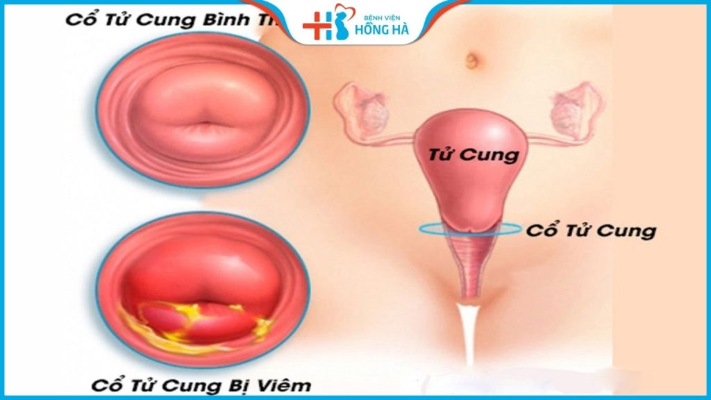 Các triệu chứng và 3 phương pháp chữa trị viêm cổ tử cung mãn tính