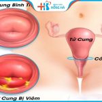 Các triệu chứng và 3 phương pháp chữa trị viêm cổ tử cung mãn tính