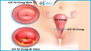 Các triệu chứng và 3 phương pháp chữa trị viêm cổ tử cung mãn tính