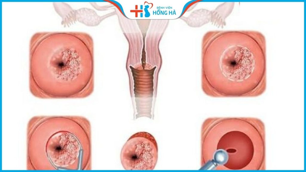 Viêm lộ tuyến cổ tử cung 0,5cm: triệu chứng và chẩn đoán