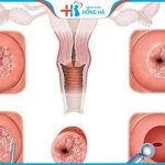 Viêm lộ tuyến cổ tử cung 0,5cm: triệu chứng và chẩn đoán