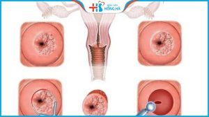 Viêm lộ tuyến cổ tử cung 0,5cm: triệu chứng và chẩn đoán