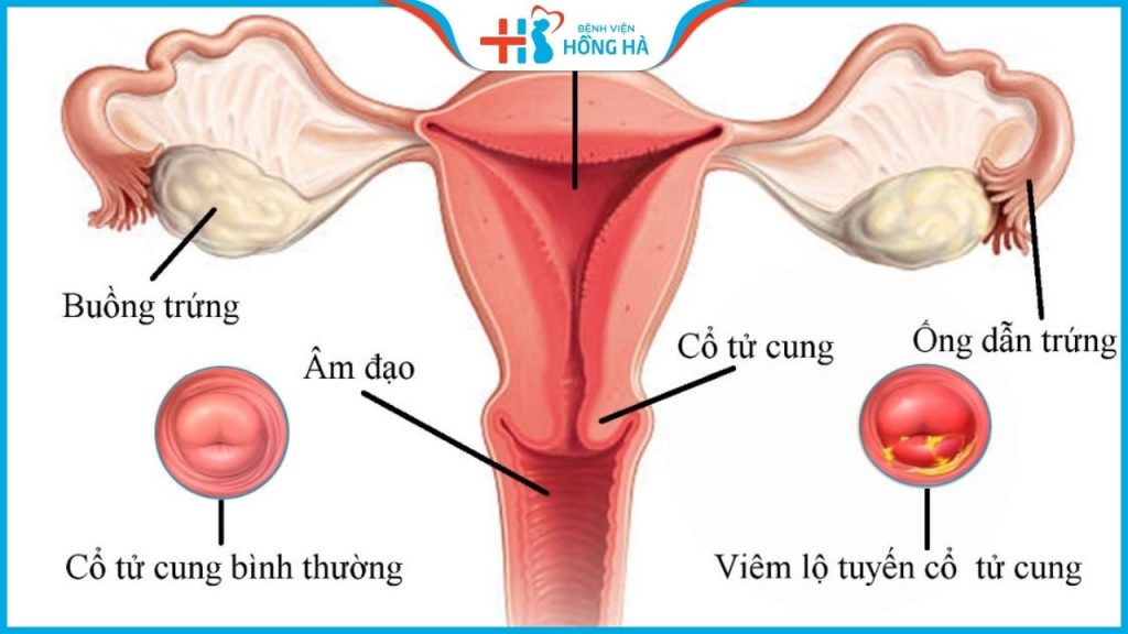 Viêm lộ tuyến cổ tử cung 8mm: Nguyên nhân, triệu chứng và điều trị hiệu quả
