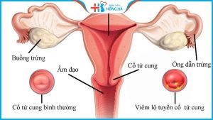 Viêm lộ tuyến cổ tử cung 8mm: Nguyên nhân, triệu chứng và điều trị hiệu quả