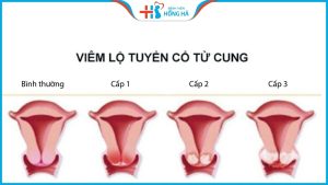 Dạng sùi trong viêm lộ tuyến cổ tử cung: Nguyên nhân và cách điều trị hiệu quả