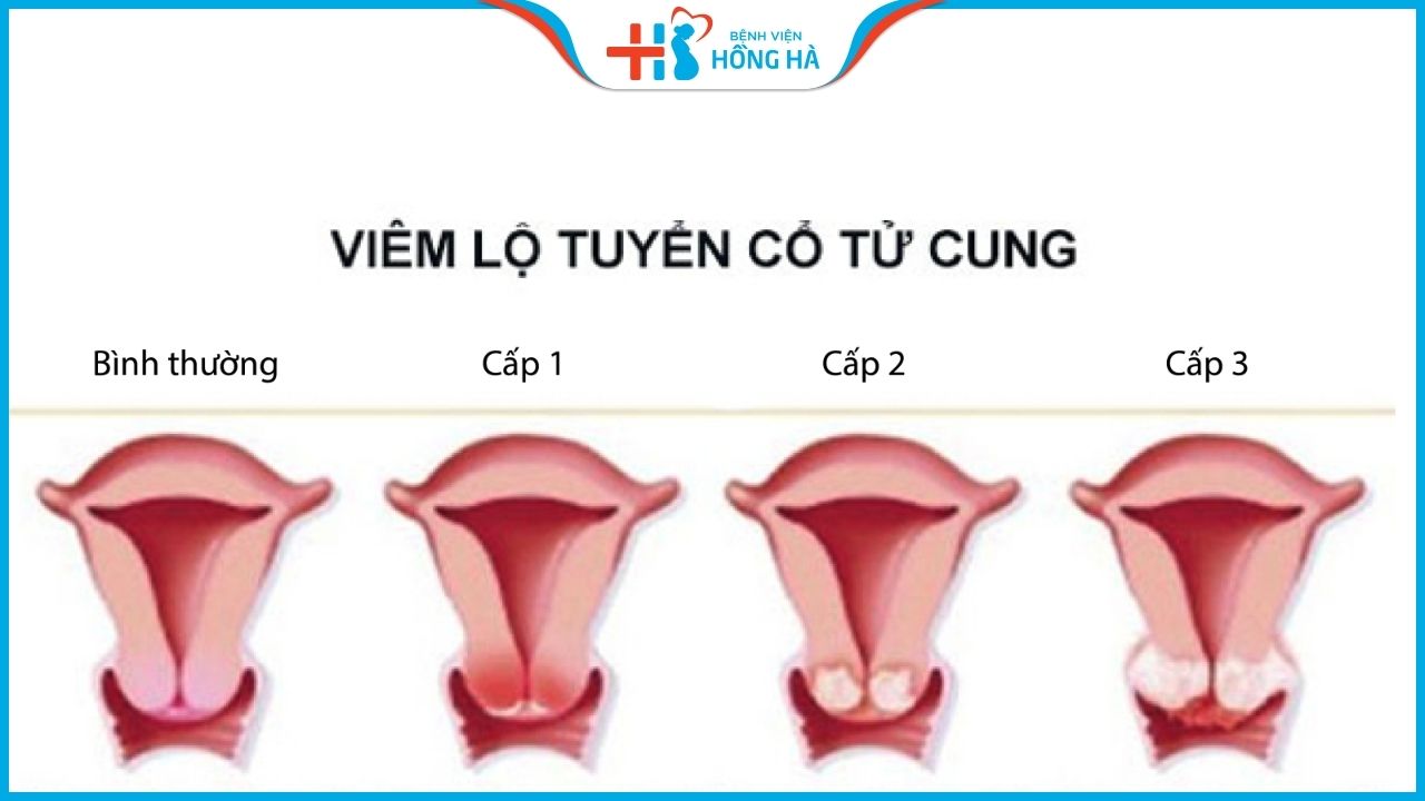 Viêm lộ tuyến cổ tử cung dạng sùi là gì?
