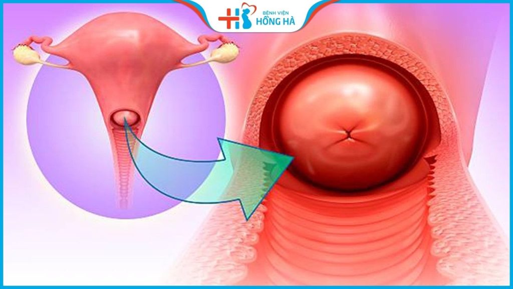 Viêm lộ tuyến tử cung: Nguyên nhân, triệu chứng và điều trị hiệu quả 80%
