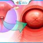 Viêm lộ tuyến tử cung: Nguyên nhân, triệu chứng và điều trị hiệu quả 80%