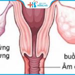 Viêm buồng trứng – nguyên nhân hàng đầu dẫn đến vô sinh ở 40% phụ nữ