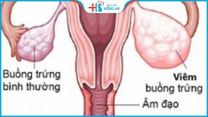 Viêm buồng trứng – nguyên nhân hàng đầu dẫn đến vô sinh ở 40% phụ nữ