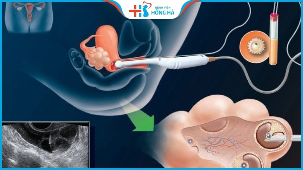 Chọc hút trứng có đau không? Kinh nghiệm để chọc hút trứng