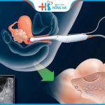 Chọc hút trứng có đau không? Kinh nghiệm để chọc hút trứng