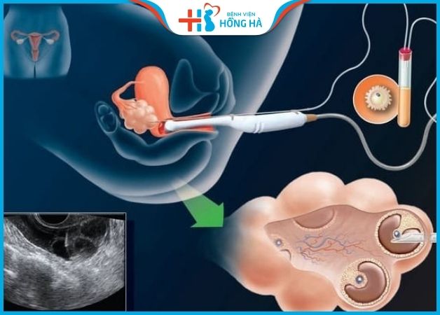 Chọc hút trứng là bước quan trọng trong quy trình IVF