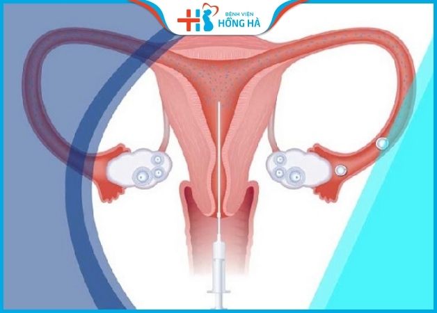 Điều trị vô sinh phụ nữ bằng phương pháp bơm tinh trùng vào tử cung