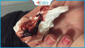 Những ảnh hưởng của kinh nguyệt màu đen tới sức khỏe sinh sản