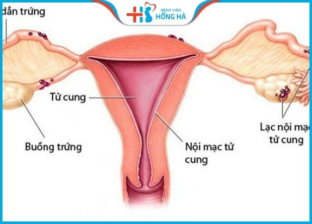 Lạc nội mạc tử cung là một trong những nguyên nhân phổ biến gây vô sinh nữ