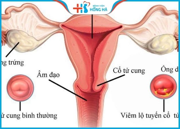 Thụ tinh nhân tạo chỉ định cho đối tượng phụ nữ vô sinh do vấn đề tử cung
