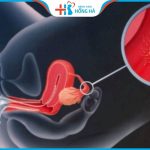 Quá trình thụ tinh nhân tạo diễn ra như thế nào?5 bước cơ bản