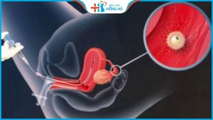 Quá trình thụ tinh nhân tạo diễn ra như thế nào?5 bước cơ bản