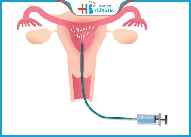 Thụ tinh nhân tạo là kỹ thuật bơm tinh trùng trực tiếp vào buồng tử cung