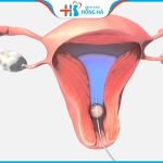 [ GÓC GIẢI ĐÁP CHUYÊN GIA] Thụ tinh nhân tạo có đau không?