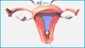 [ GÓC GIẢI ĐÁP CHUYÊN GIA] Thụ tinh nhân tạo có đau không?