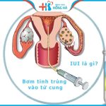Thụ tinh nhân tạo IUI là gì? Quy trình thụ tinh nhân tạo thực hiện ra sao?