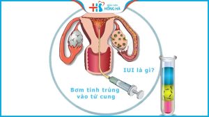 Thụ tinh nhân tạo IUI là gì? Quy trình thụ tinh nhân tạo thực hiện ra sao?