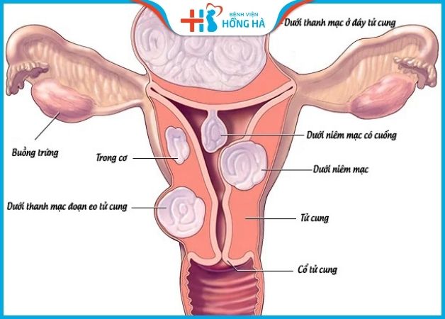 Thụ tinh ống nghiệm áp dụng cho trường hợp nữ giới bị u xơ tử cung
