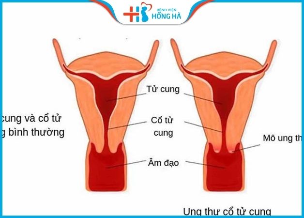 Viêm lộ tuyến cổ tử cung là tình trạng viêm nhiễm xảy ra ở cổ tử cung