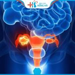 Các nguyên nhân và điều trị bệnh viêm lộ tuyến và ung thư cổ tử cung